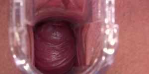 Outdoor Gyno