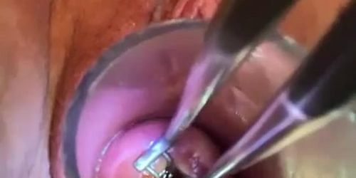 cervix open