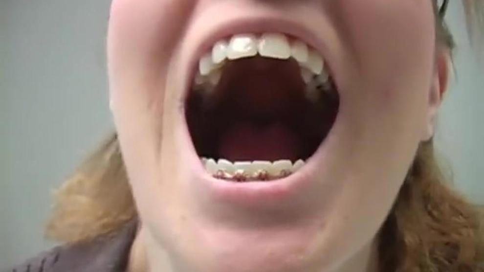 Kat Surth Braces Mouth Fetish Porn Videos