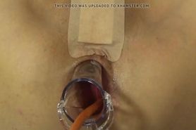 Elmer's Wife Anal fisting speculum 4