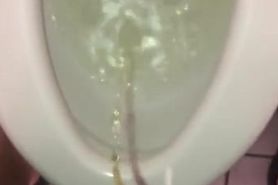 Phimosis pee