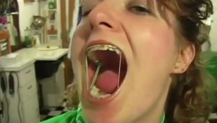 Kat Braces Sexy - Mouth/Tongue fetish hot girl braces with elastics - Tnaflix.com, page=3