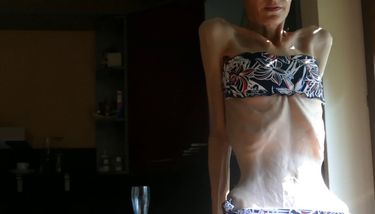 Skinnyfans Skinny Anorexic